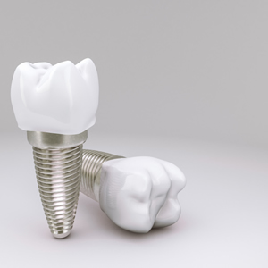 talita chimeli - odontologia em brasilia - dentista em brasilia - implante dental 300