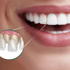 talita chimeli - odontologia em brasilia - dentista em brasilia - lente de contato 300